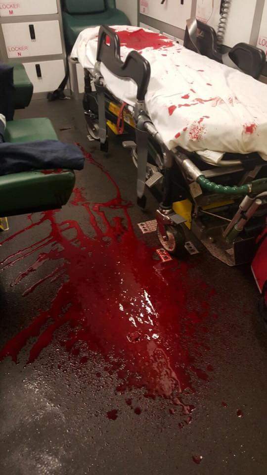 Managing Amputations in High-Risk Environments: Essential Skills for Emergency Response